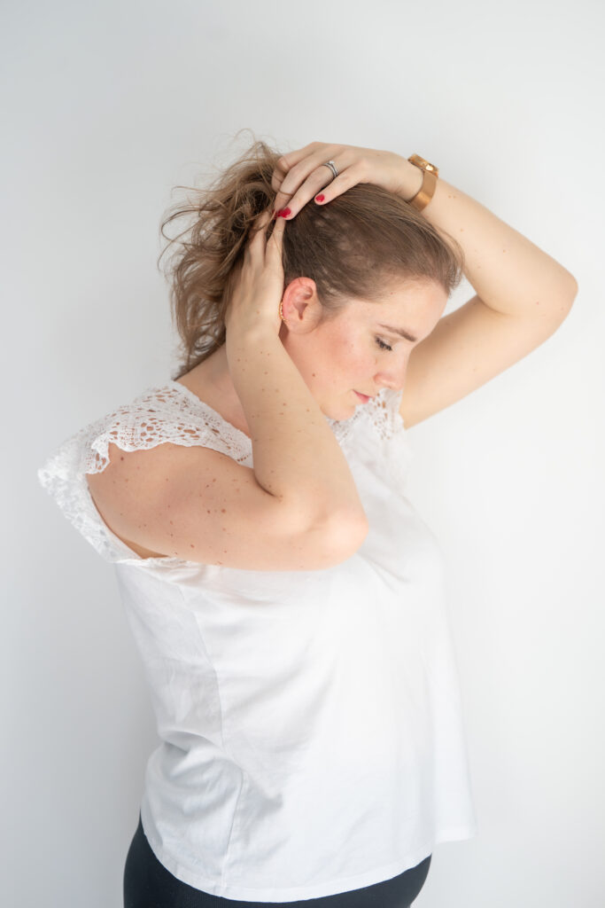 photo alopécie femme