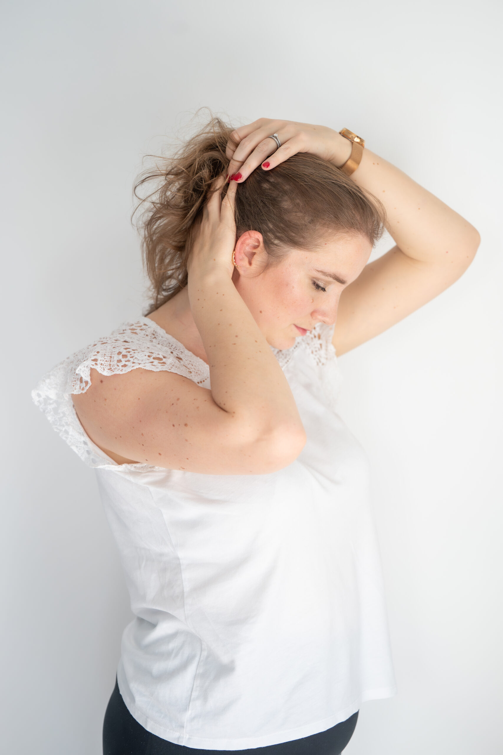photo alopécie femme